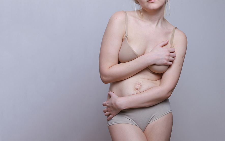 What is the Difference between Belt Lipectomy & Tummy Tuck? 