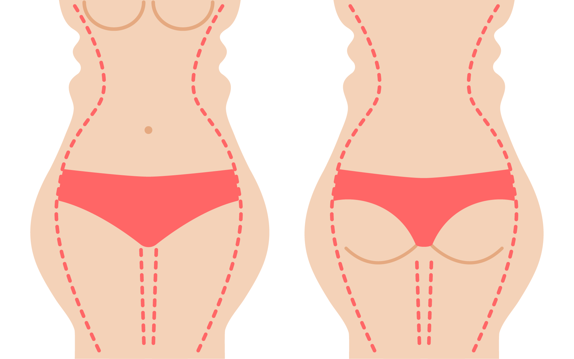 A, C, E) This 63-year-old woman presented for body contouring. (B, D